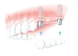 Zubní implantáty s můstkem