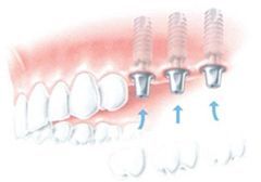 Zubní implantáty s korunkou