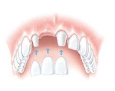 Zubní můstek